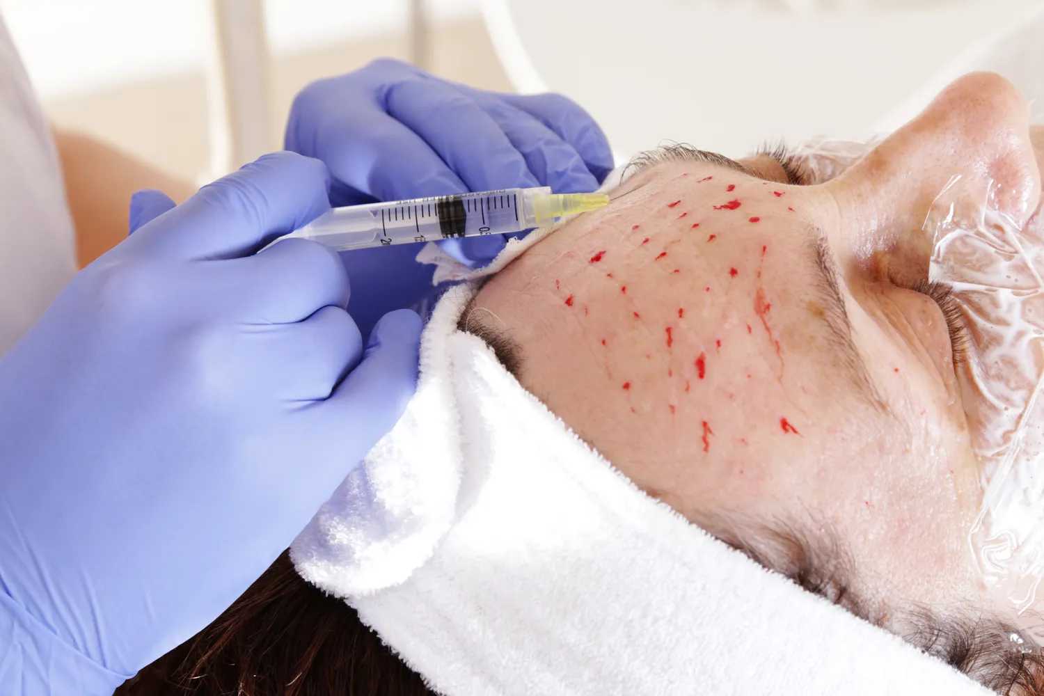 Czy kwas hialuronowy się wchłania?