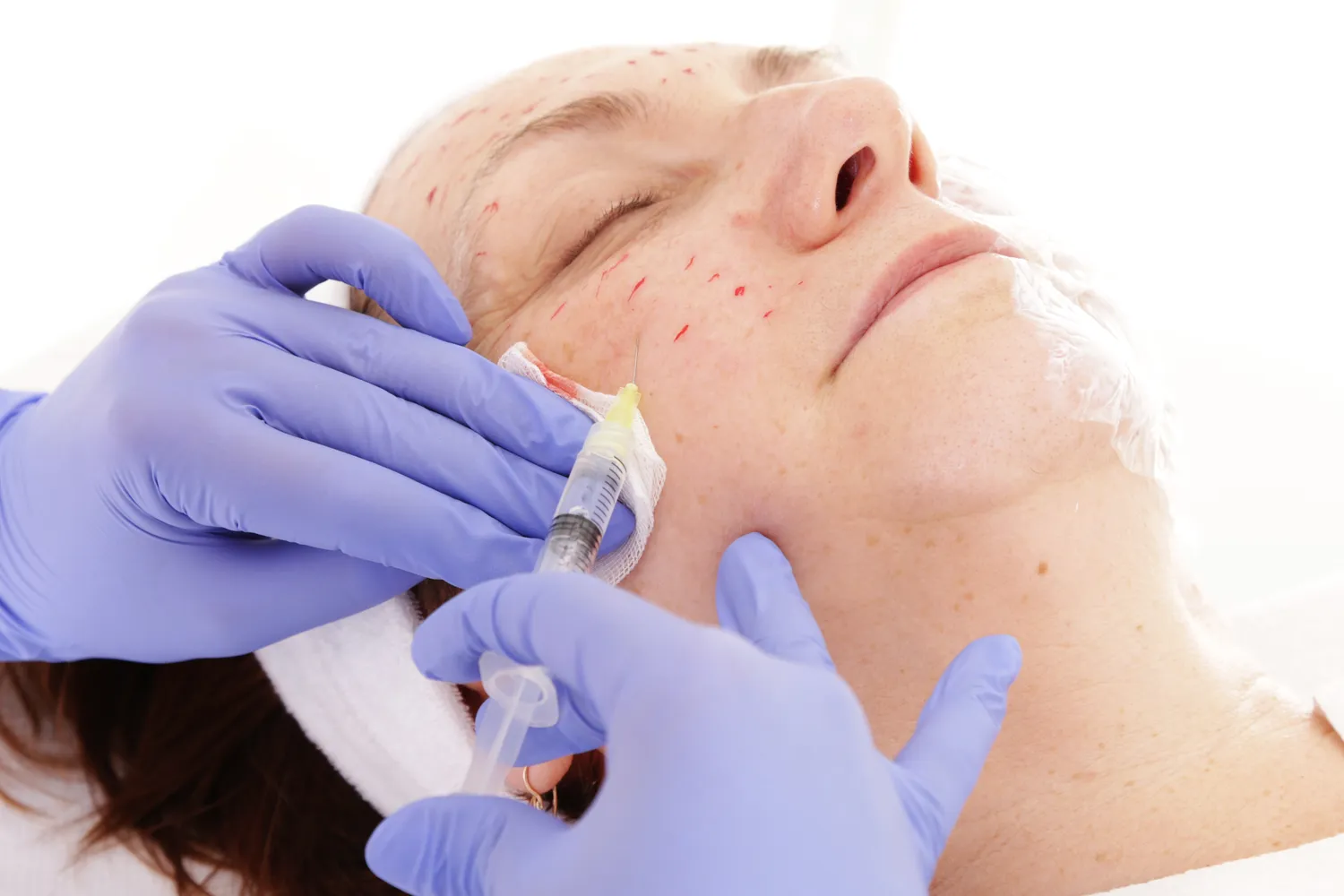 Ile kosztuje kwas hialuronowy?