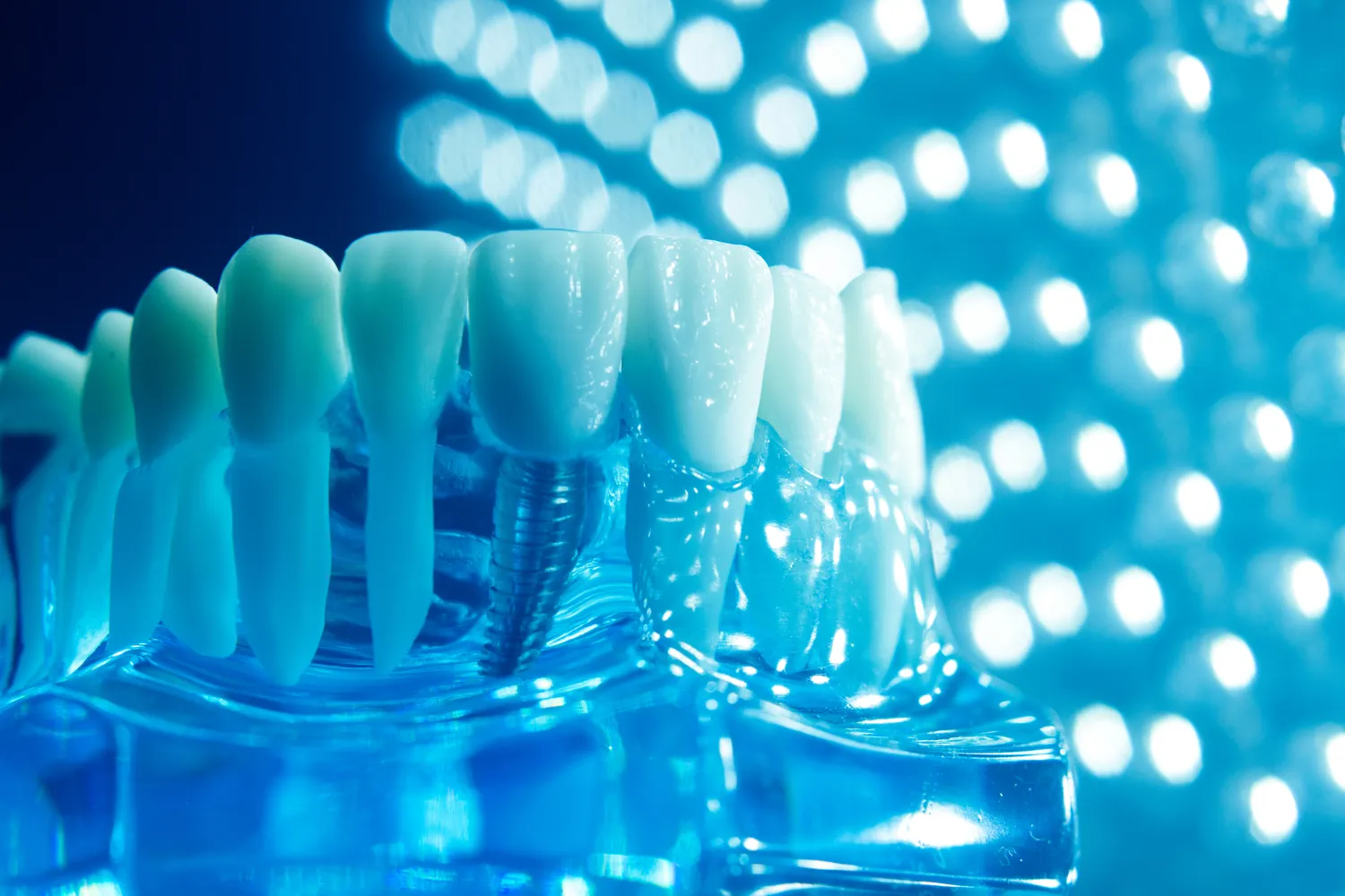 Implanty zębowe Warszawa cena