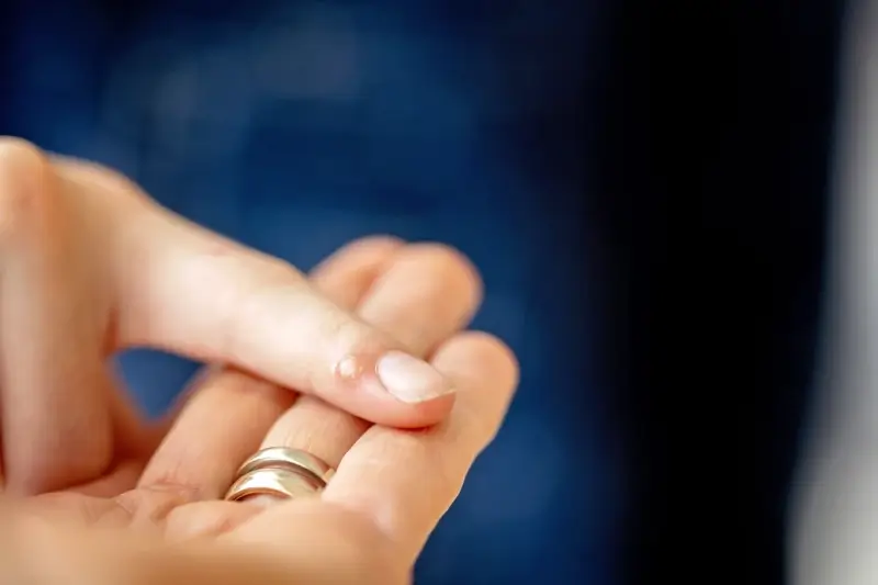 Co ile zamrażać kurzajki?